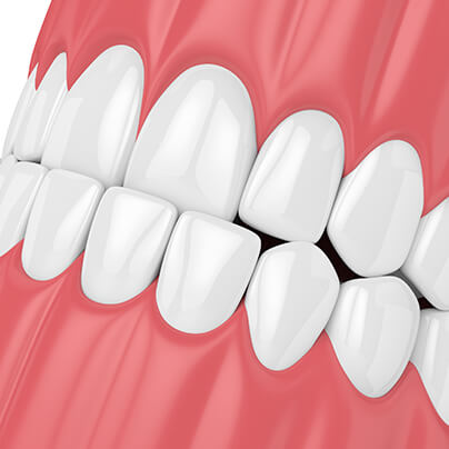 Má oclusão dentária